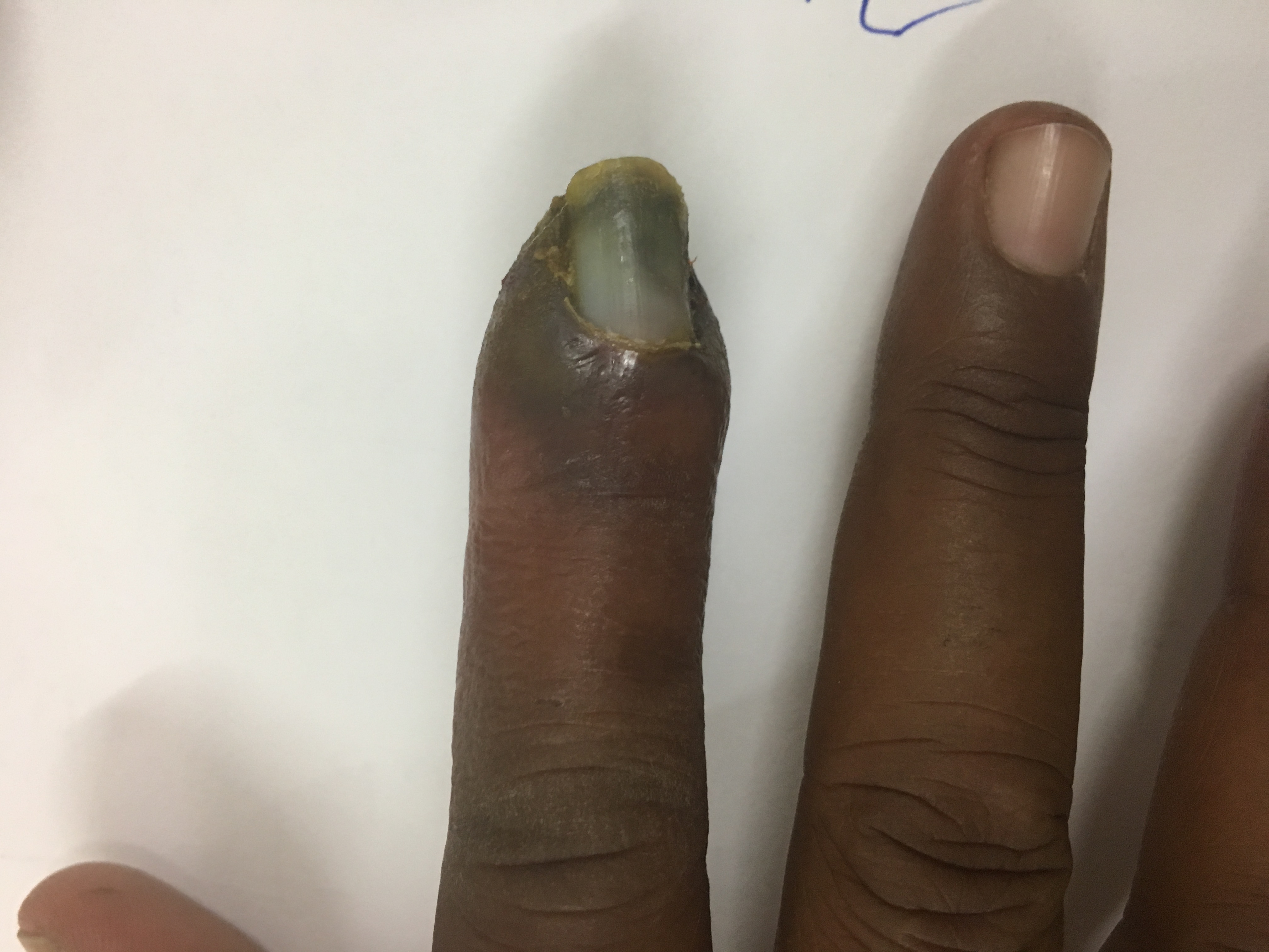 Identify The Condition Of Index Finger